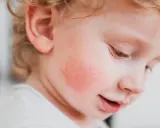 Un enfant avec une rougeur sur la joue, possiblement du pityriasis alba.
