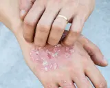 Main d'une personne se grattant des plaques rouges et squameuses, possiblement liées au psoriasis en goutte.