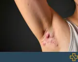 Gros plan sur des boutons sous les aisselles, certains enflammés, sur la peau d'une personne.