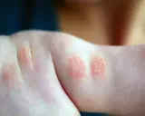 Plaques rouges et squameuses sur le bras d'un enfant, signe d'un petit bouton sur les bras allergie.