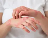 Mains atteintes de plaques rouges et squameuses, signe d'un psoriasis. La cause exacte reste complexe.