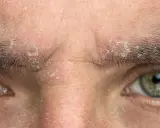 Gros plan sur le visage d'une personne, montrant une peau sèche et squameuse autour des yeux et sur le front. Une pellicule sourcil est visible, indiquant une irritation cutanée.