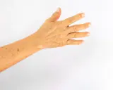 Bras avec des taches solaires, marques du temps et du soleil sur la peau.