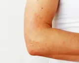 Plaques rouges et irritées sur le coude, signe d'eczéma.