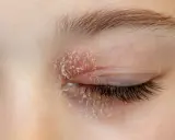 Peau sèche et squameuse sur la paupière, symptôme d'eczéma aux yeux. Cause possible : réaction allergique ou irritant.