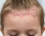 Psoriasis sur le cuir chevelu d'un bébé, avec des plaques rouges et squameuses le long de la ligne des cheveux.