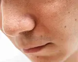 Gros plan sur le nez et la bouche, révélant une peau texturée avec de nombreux pores et un point noir spectaculaire.