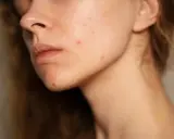 Visage d'une jeune femme avec des rougeurs et des marques de cicatrice acné sur la joue et le menton.