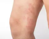 Plaques rouges et squameuses sur la cuisse, indiquant un **eczéma cuisse**. La peau semble irritée et sèche.