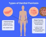 Illustration des types de psoriasis génital, y compris le psoriasis inversé et le psoriasis en plaques, qui peuvent affecter le pénis.