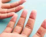 Mains affectées par la dyshidrose, avec des vésicules et une peau qui pèle sur les doigts.