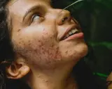 Visage d'une jeune femme aux cheveux sombres, le regard levé, présentant une acné inflammatoire marquée sur la joue et le cou. Une feuille verte effleure son front.