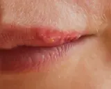 Gros plan sur une lèvre avec un bouton de fièvre rouge et enflammé, suggérant un traitement en cours.