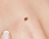 Gros plan sur une peau humaine, montrant une texture légèrement granuleuse, un grain de beauté brun et le bord des lèvres.