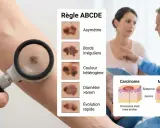 Examen d'un grain de beauté suspect pour détecter un cancer de la peau. La règle ABCDE aide à identifier les signes d'alerte.