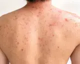 Le dos d'une personne présente de nombreuses imperfections rouges et enflammées, typiques de l'acné du dos.