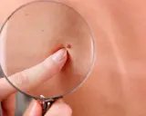 Un doigt pointe un grain de beauté rouge sous une loupe, examinant attentivement la peau.