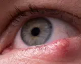 Gros plan sur un œil avec une tache rouge sur la paupière supérieure, près des cils.