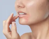 Une femme touche sa bouche, présentant une rougeur autour des lèvres, symptôme de dermatite periorale.