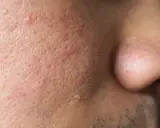 Gros plan sur la peau d'un visage, montrant des pores dilatés et une petite verrue sur la joue.