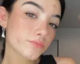Gros plan sur le visage d'une jeune femme aux yeux marron, avec un bouton sur le front et des boucles d'oreilles.