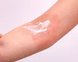 Application de crème sur une peau rouge et irritée, symptôme de dermatite atopique.