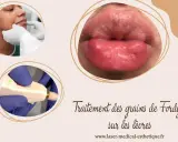 Traitement des grains de Fordyce sur les lèvres. Un petit bouton blanc sur la lèvre peut être traité.