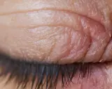 Gros plan sur un œil fermé, montrant la peau irritée et squameuse typique de l'eczéma paupière.