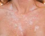 Poitrine et cou d'une personne avec une peau tachetée, montrant des zones de pigmentation inégale dues à l'exposition au soleil.