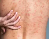 Une main gratte le dos couvert de plaques rouges, signe d'urticaire due au stress.