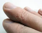 Gros plan sur des doigts montrant une peau sèche et craquelée, avec une crevasse visible sur un doigt.