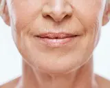 Gros plan sur le visage d'une femme, montrant les rides et ridules qui témoignent du vieillissement de la peau.