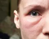 Un visage gonflé, peut-être un œdème, cherche un remède de grand-mère. Gros plan sur l'œil et la joue rougie.