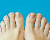 Gros plan sur des pieds montrant des ongles jaunis et épaissis, symptômes possibles de psoriasis ongle pied.