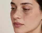 Visage d'une femme avec des taches brunes sous les yeux, évoquant le masque de grossesse du 1er trimestre.