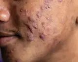 Gros plan sur une peau marquée par de nombreux boutons d'acné, dont un acné nodule particulièrement visible.