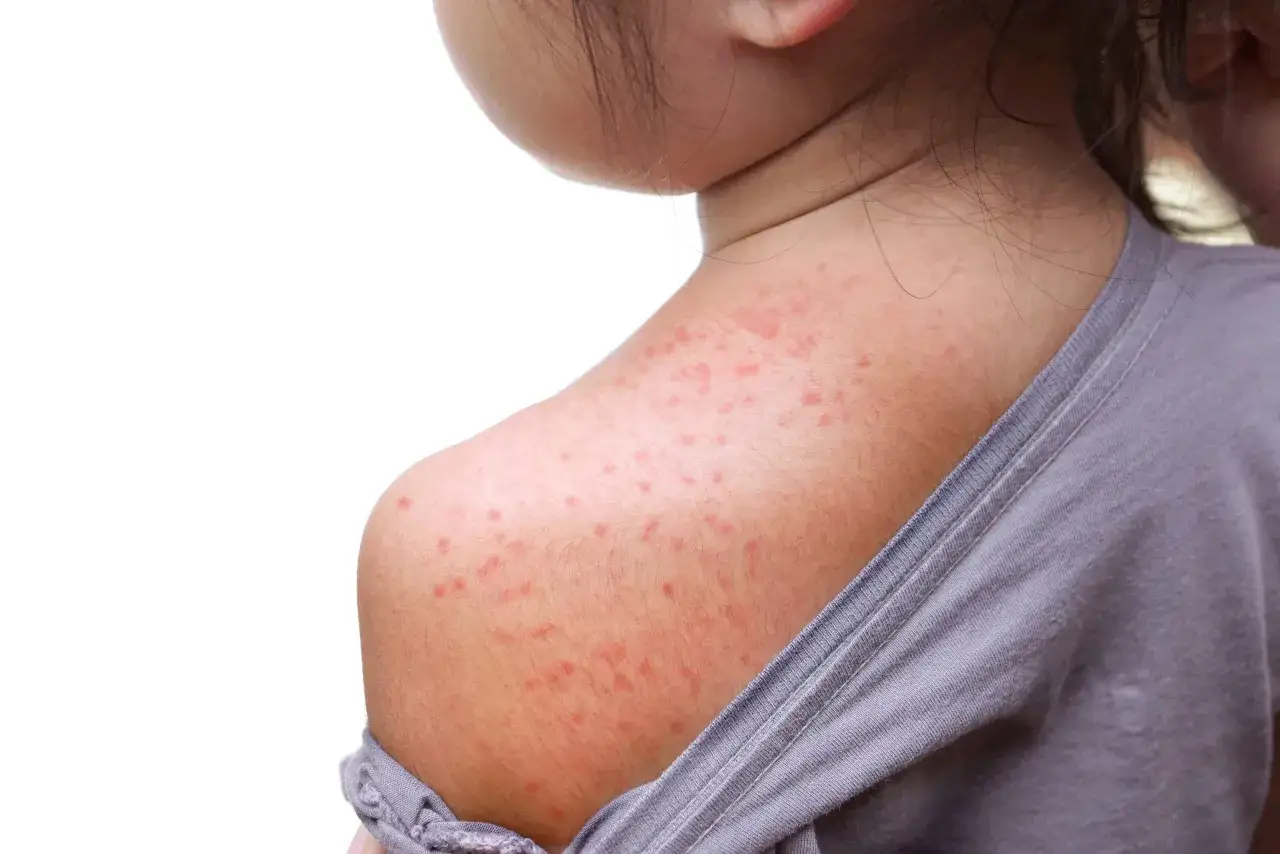 Un enfant a des rougeurs et des petites plaques sur le dos, signe d'eczéma.