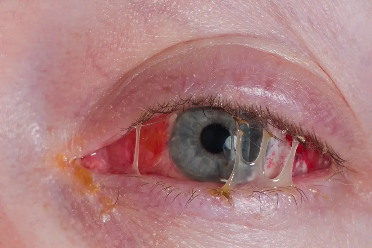 Œil rouge et irrité avec un écoulement épais, suggérant une mycose autour des yeux. La peau est gonflée et des filaments jaunes sont visibles.