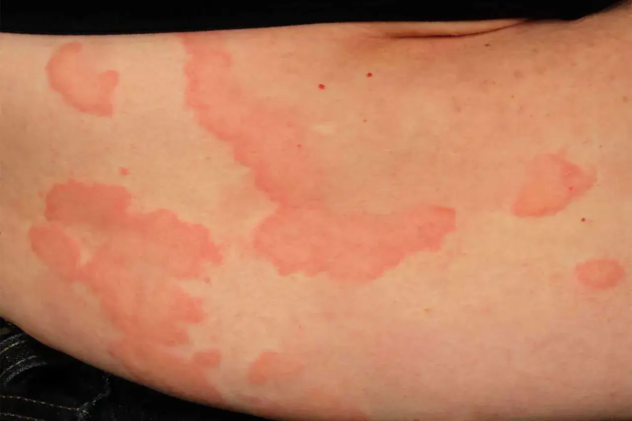 Grosses plaques rouges et surélevées sur la peau, typiques d'une urticaire due au stress.