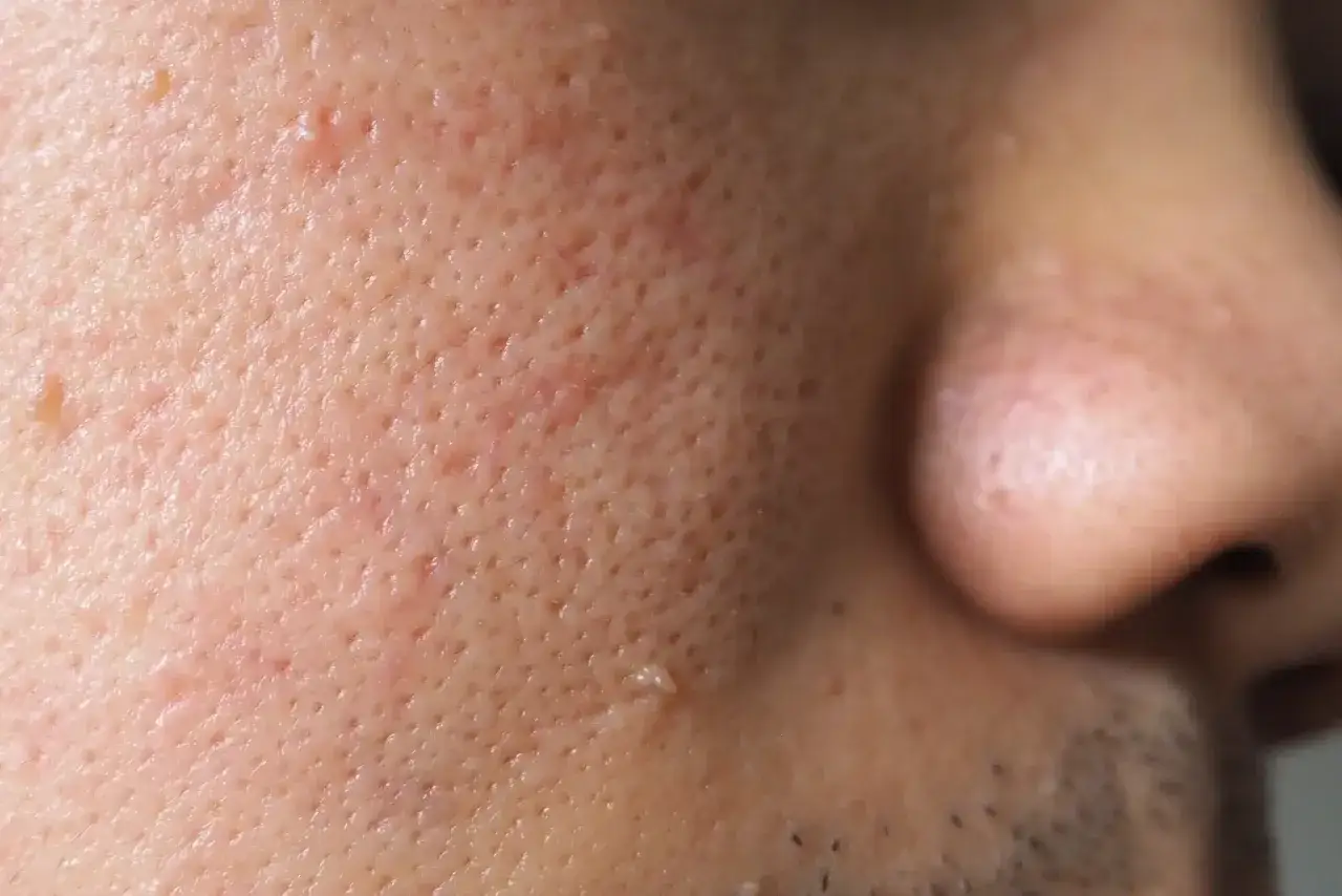 Gros plan sur la peau d'un visage, montrant des pores dilatés et une petite verrue sur la joue.
