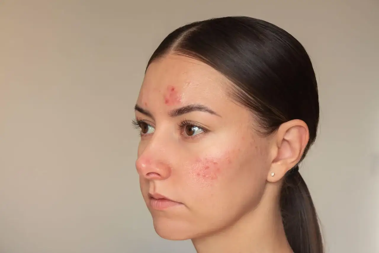 Visage d'une jeune femme avec des rougeurs et des plaques, évoquant le psoriasis du visage.