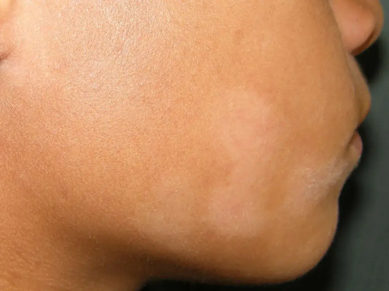 Pityriasis alba : des plaques claires et sèches sur la joue d'un enfant, une affection cutanée bénigne.