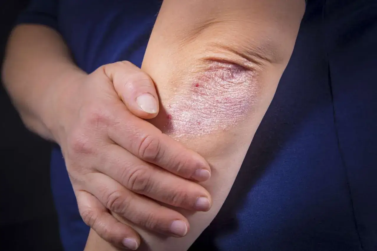 Psoriasis sur le coude, une affection cutanée avec des plaques rouges et squameuses.