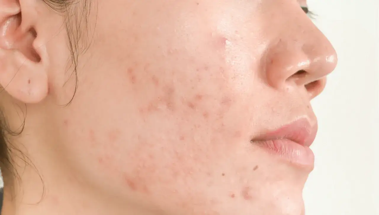 Gros plan sur une joue avec des marques d'acné et un bouton de stress visible, témoignant des effets du stress sur la peau.