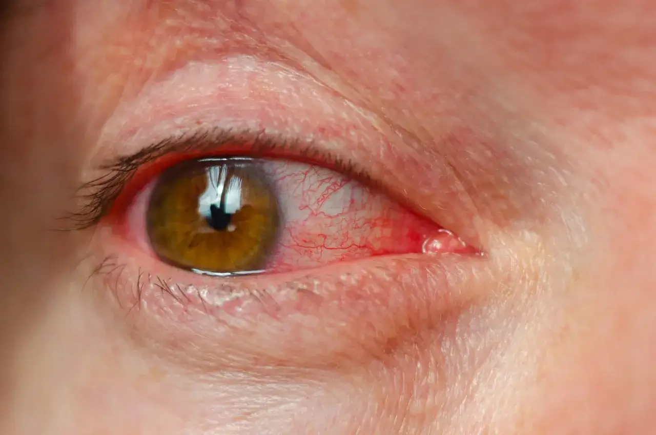 Œil humain avec une tache rouge sur la paupière supérieure, signe d'irritation ou d'inflammation.