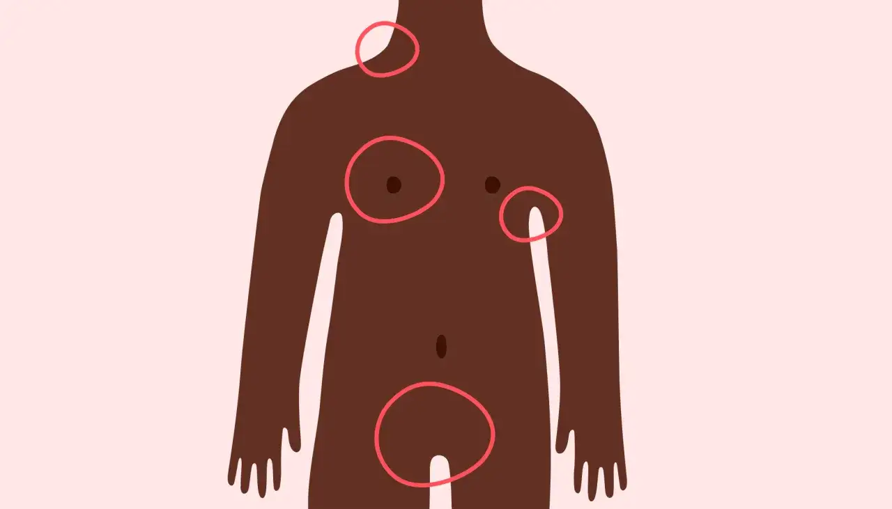 Silhouette d'une personne avec des cercles rouges indiquant des zones de peau, peut-être un gros bouton sous la peau douloureux.