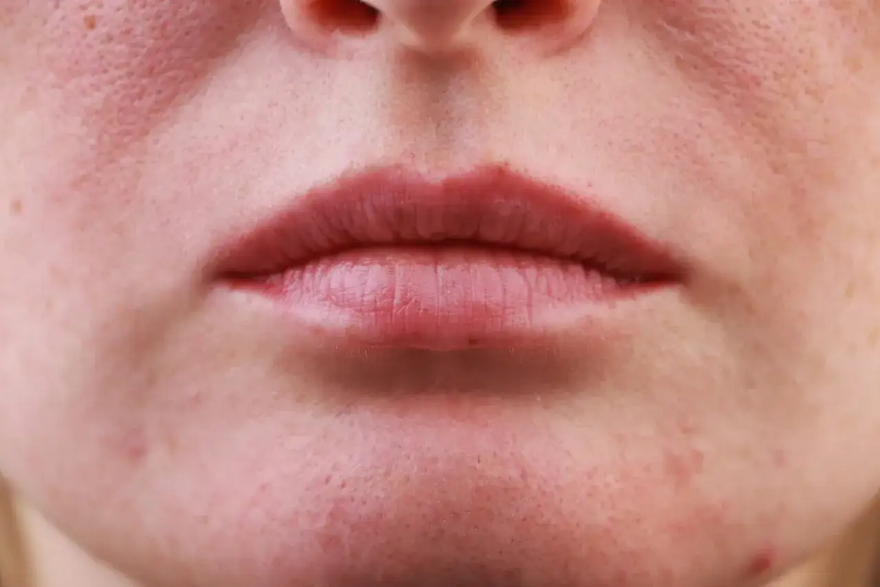 Gros plan sur une bouche et un menton, révélant une peau avec des pores dilatés et une légère plaque rouge visage.