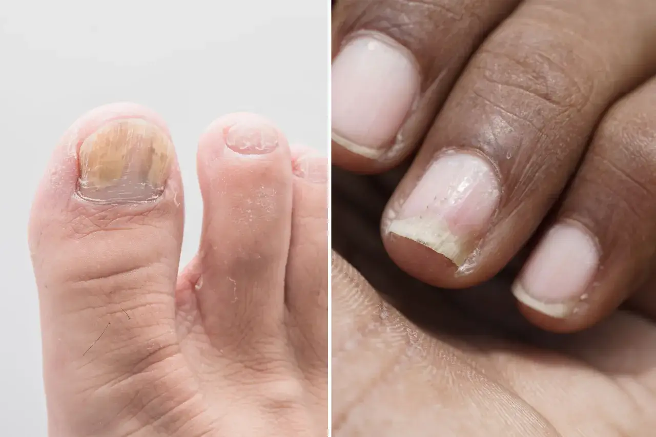 Gros plan sur un ongle de pied atteint de psoriasis, montrant une décoloration et une texture irrégulière.