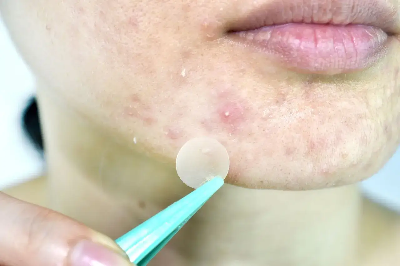 Une pince applique un patch boutons sur une peau sujette aux imperfections.