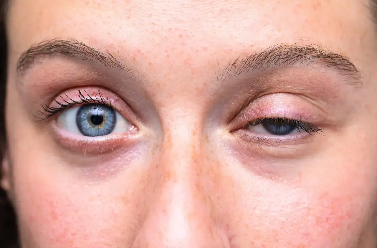 Gros plan sur un visage, montrant un œil bleu vif et un œil gauche avec une poche sous l'œil gonflée, peut-être due à la fatigue ou à une allergie.